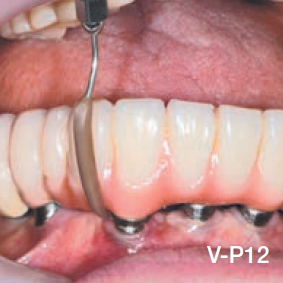 V-P12 (NSK, Япония) - набор насадок Varios для ухода за имплантами (более длинная версия  V-P10) к ультразвуковым скалерам NSK и Satelec, 3 шт. в упаковке Продажа стоматологического оборудования в Санкт-Петербурге