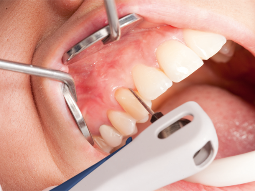 картинка Кюрета Recall CFK - поддерживающая терапия на аппаратах Vector Paro и Vector Paro Pro (Dürr Dental, Германия)  от Алдент