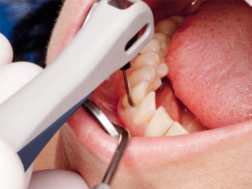 картинка Набор инструментов Recall/Implant - поддерживающая терапия  на аппаратах Vector Paro и Vector Paro Pro (Dürr Dental, Германия) от Алдент