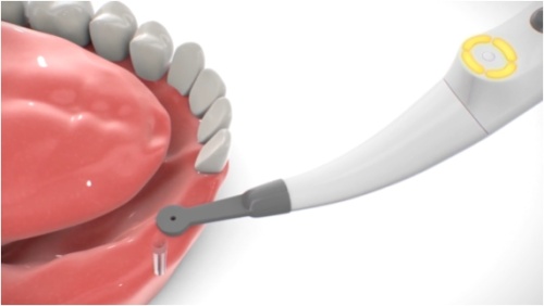 картинка Implant Locator (имплант-локатор) - прибор для точного определения расположения стоматологических имплантов Forum (Израиль) от Алдент