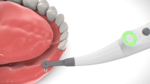 картинка Implant Locator (имплант-локатор) - прибор для точного определения расположения стоматологических имплантов Forum (Израиль) от Алдент